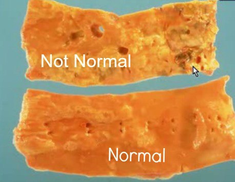 Aortic atherosclerosis