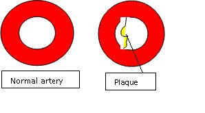 atheroslerosis plague